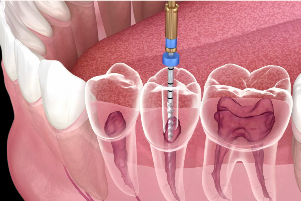 Endodontist Root Canal