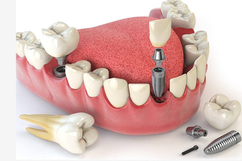 Implantology